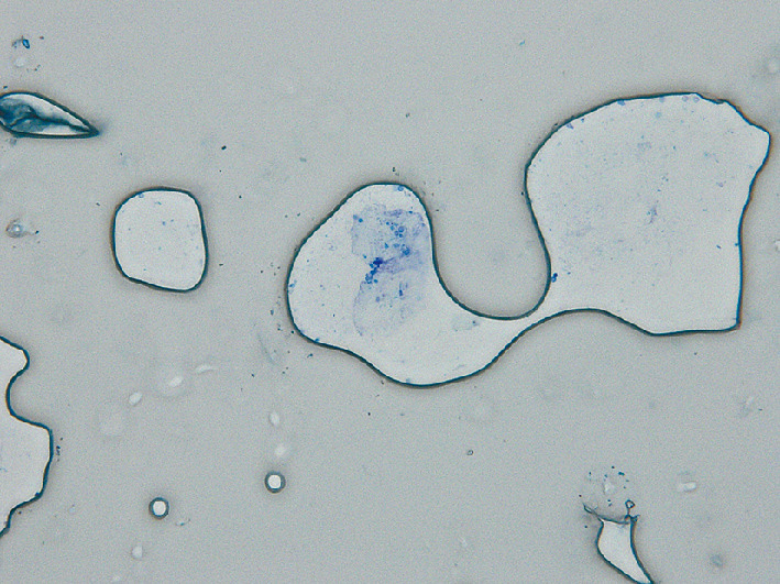 ⓔ図7-5-23　酸性メチレンブルー染色で観察するマラセチアの直接鏡検像 カンジダとは異なりカラレットという首飾り状に発芽する酵母を認める．