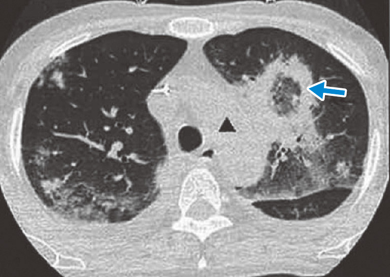 ⓔ図7-5-4　肺ムーコル症 50歳代，女性．基礎疾患は急性骨髄性白血病 (AML)．C. bertholletiaeによる肺ムーコル症の逆ハローサイン．