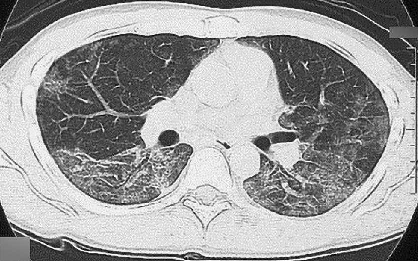 ⓔ図7-5-6　ニューモシスチス肺炎のCT所見 両肺びまん性にすりガラス様陰影がみられる．