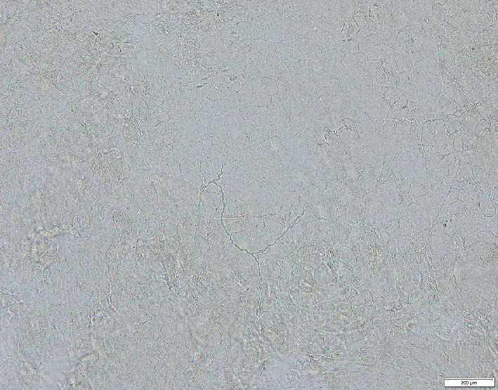 ⓔ図7-5-9　足白癬のKOH直接鏡検査所見 Trichophyton interdigitale弱拡大像．分節を有する菌糸と螺旋を思わせるうねるような菌糸を認める．
