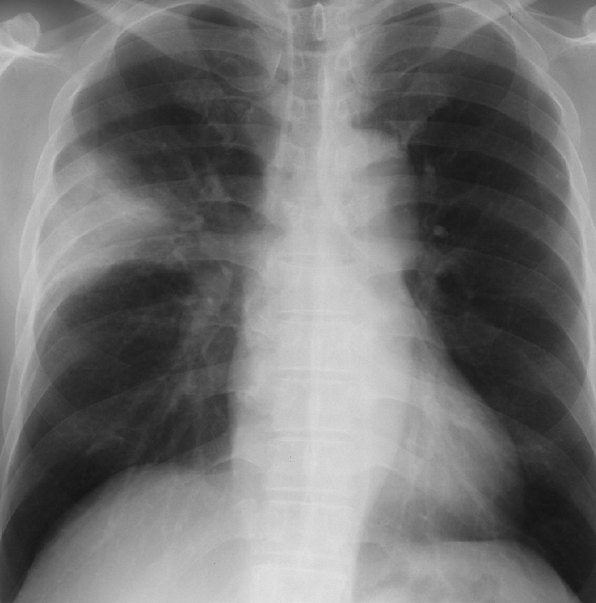 ⓔ図7-8-1　Q熱の胸部X線像1 59歳，男性．トリを飼育．β–ラクタム系薬無効→ミノサイクリン投与で改善．コクシエラⅡ相菌IgG抗体価の有意上昇あり (ペア血清)．右上肺野外側に非常に濃厚な浸潤影が広がっている．