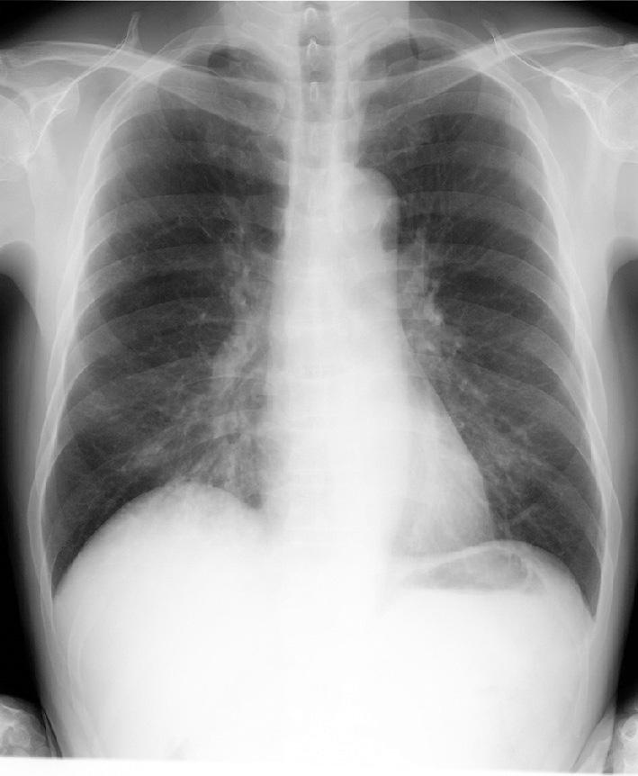 ⓔ図7-8-2　Q熱の胸部X線像2 62歳，男性．イヌを飼育．ミノサイクリン投与にて改善．コクシエラⅡ相菌IgG抗体価の有意上昇あり (ペア血清)．右下肺野横隔膜上および一部左下肺野にも非特異的な気管支肺炎像が認められる．
