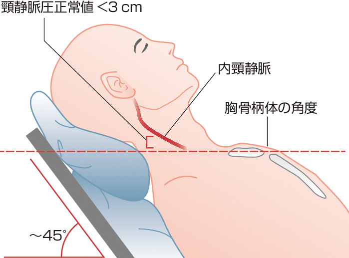 ⓔ図8-1-1　内頸静脈の観察による非観血的中心静脈圧の推定法 (日本循環器学会・日本心不全学会：急性・慢性心不全診療ガイドライン (2017年改訂版)) 