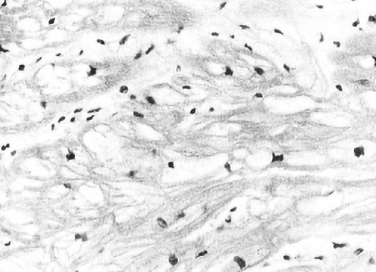 ⓔ図8-13-2　心Fabry病におけるHE染色画像 (×100) 心筋細胞内に著明な空胞変性をびまん性に認める．