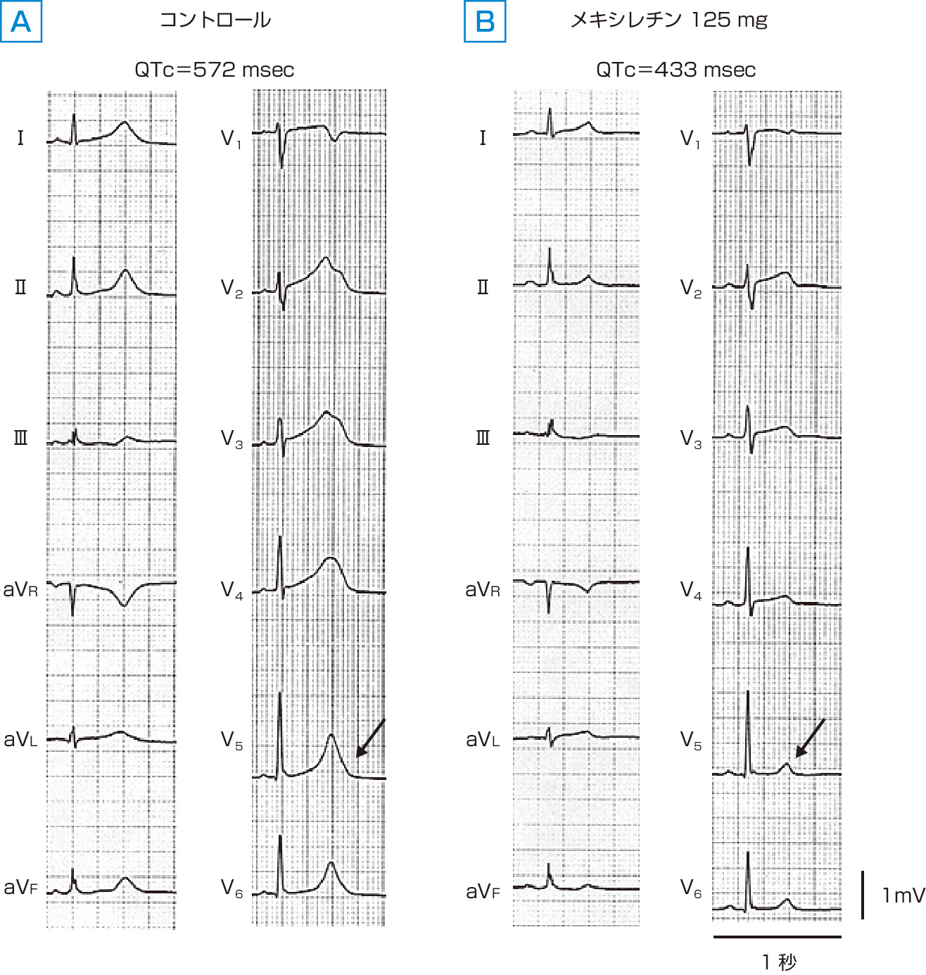 ⓔ図8-4-3　LQT3患者におけるメキシレチンの効果 メキシレチン125 mgの静注により，QTc時間はコントロール時の572 msec (A) から433 msecへと著明に短縮し，正常化している (B)．