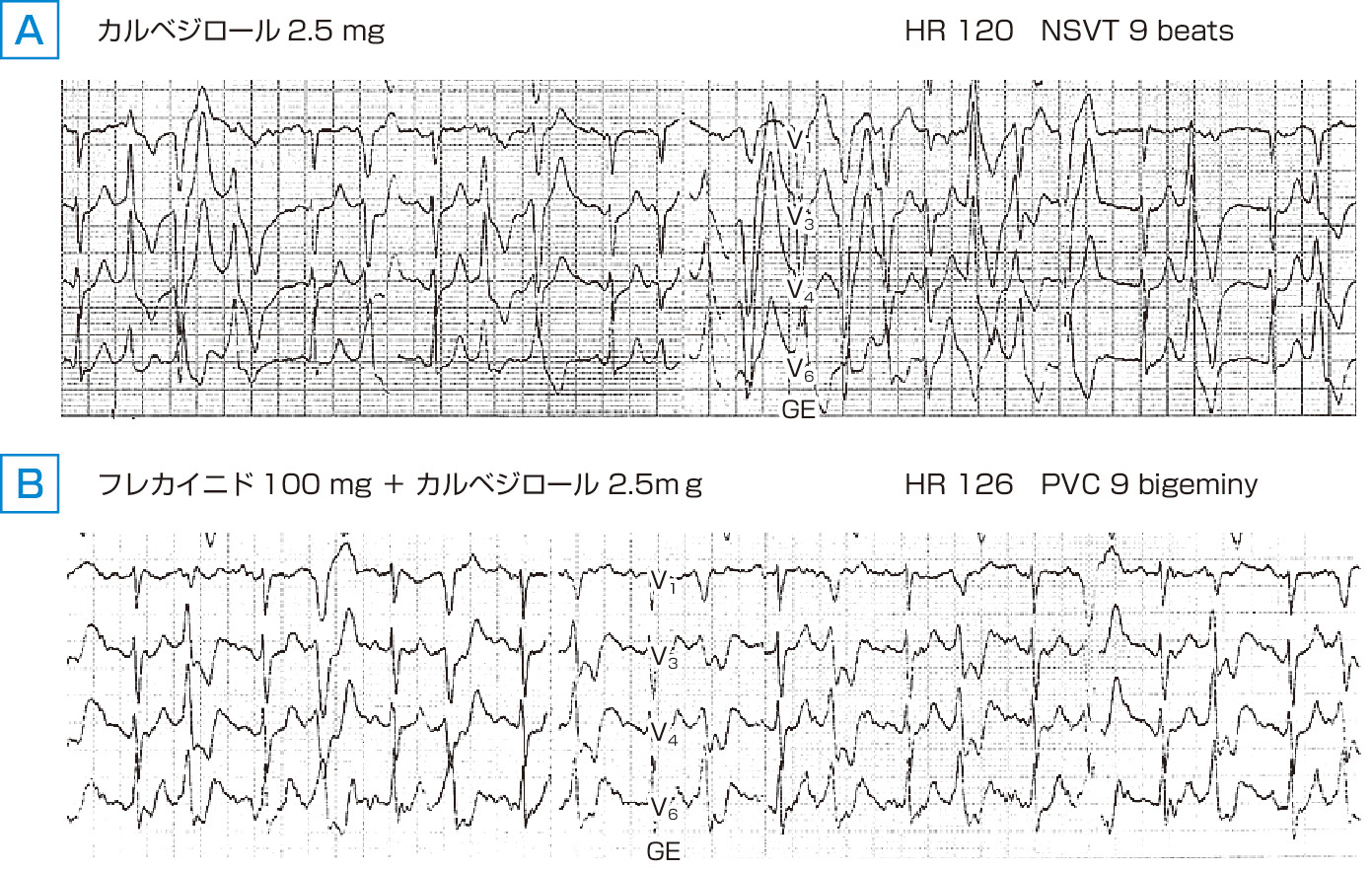 ⓔ図8-4-6　カテコールアミン誘発多形性心室頻拍 (CPVT) 患者に対するフレカイニドの有効性 リアノジン受容体遺伝子 (RyR2) 変異陽性．39歳，女性．β 遮断薬であるカルベジロール2.5 mg/日単独内服中のトレッドミル運動負荷試験では，心拍数が120回/分に上昇した時点で，非持続型心室頻拍 (NSVT) 9連発を認めたが (A)，フレカイニド100 mg/日を併用すると，心拍数が126回/分に上昇した時点でもNSVTは認めず心室期外収縮の二段脈 (PVC bigeminy) までとなった (B)．