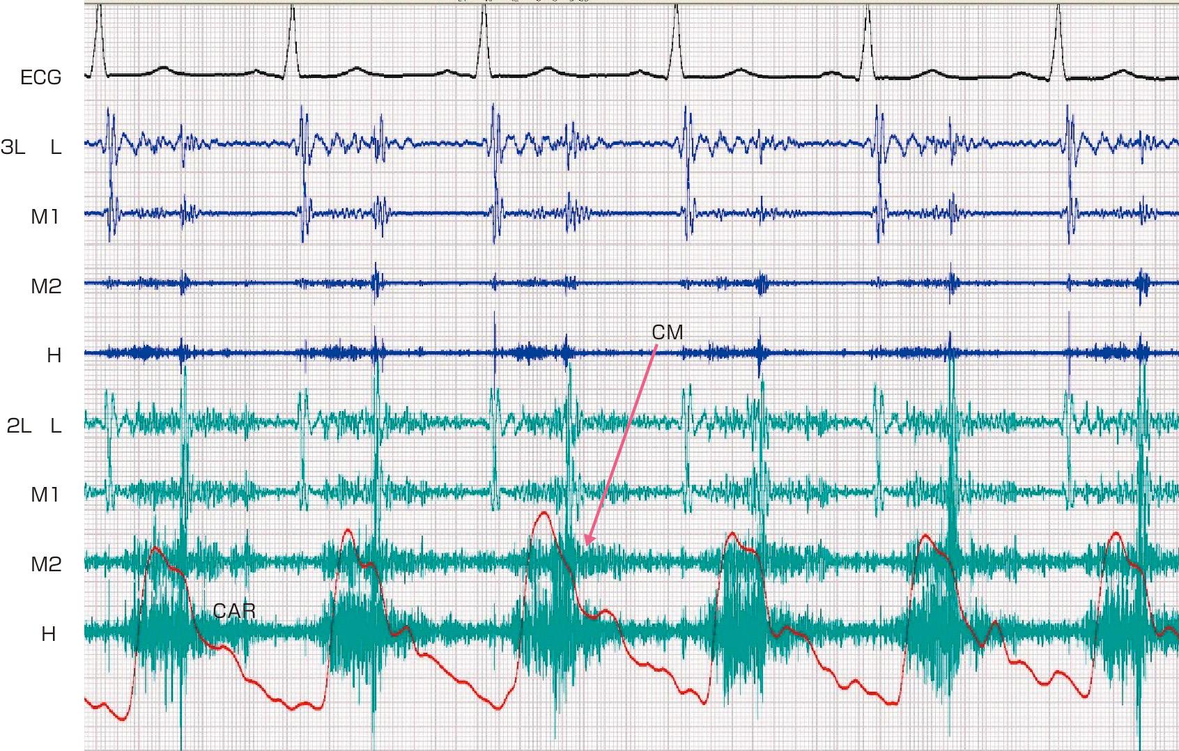 ⓔ図8-5-10　連続性雑音 (動脈管開存症) 2Lで収縮期強勢の連続性雑音 (CM) が記録されている．