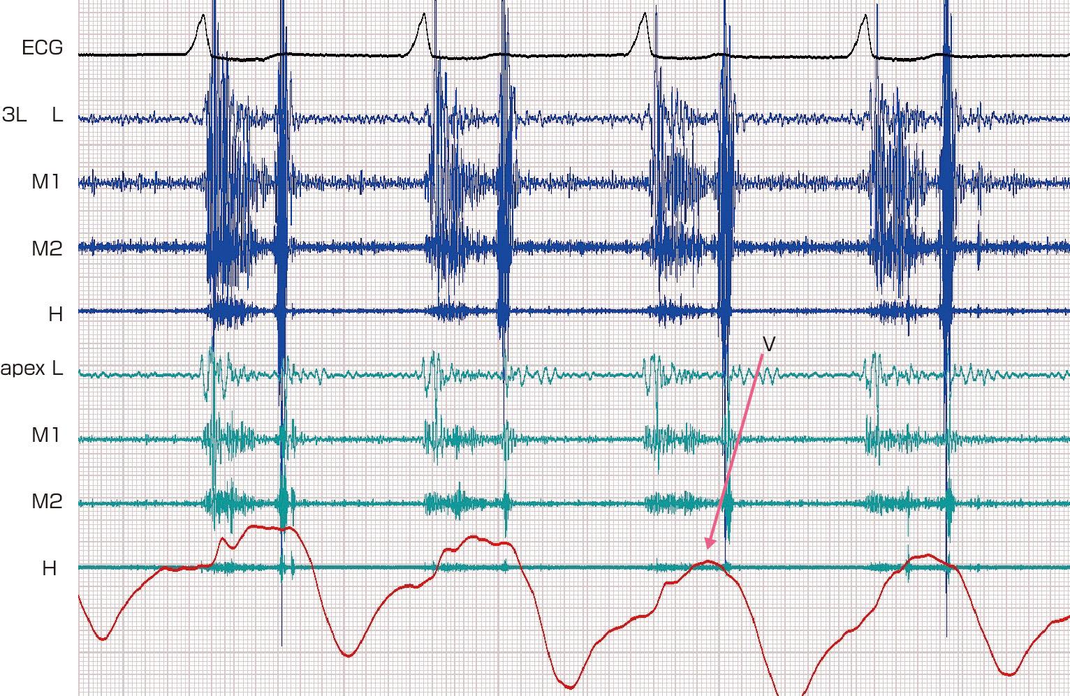 ⓔ図8-5-11　頸静脈波形のv波 (三尖弁閉鎖不全例) 頸静脈波でx谷は消失し，変わってv波の増高を認める．