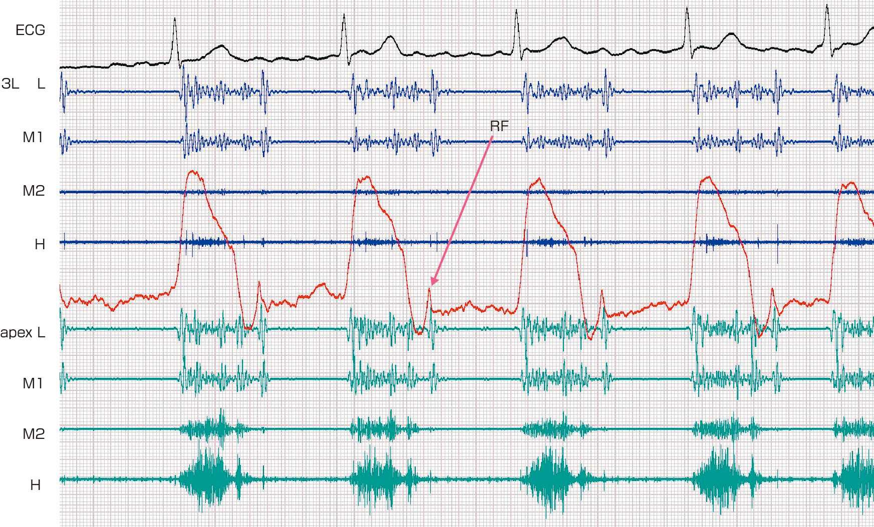 ⓔ図8-5-12　rapid filling wave (RF) (僧帽弁閉鎖不全例) 心尖拍動図で拡張早期にRFが記録されている．