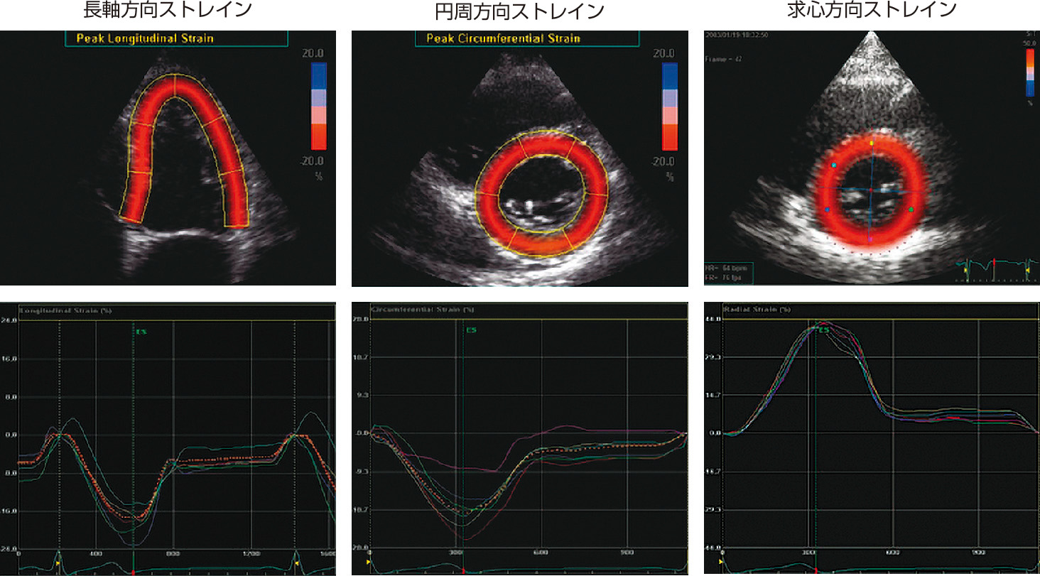 ⓔ図8-5-13　スペックルトラッキング法により求めた各方向心筋ストレイン 