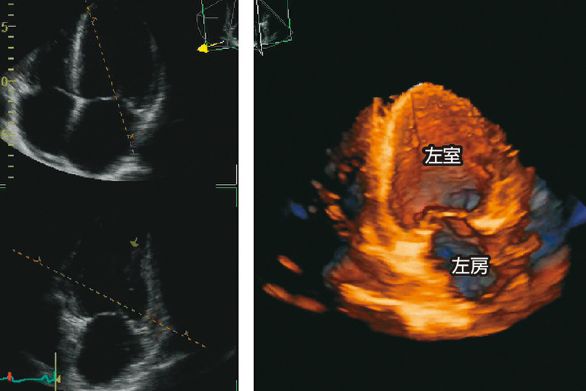 ⓔ図8-5-15　経胸壁三次元心エコー法で描出された左房と左室 