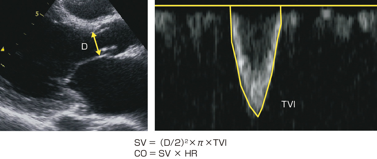 ⓔ図8-5-19　1回拍出量，心拍出量の計測 D：大動脈弁輪径，TVI：左室流出路血流速の時間速度積分値，SV：1回拍出量，CO：心拍出量，HR：心拍数．