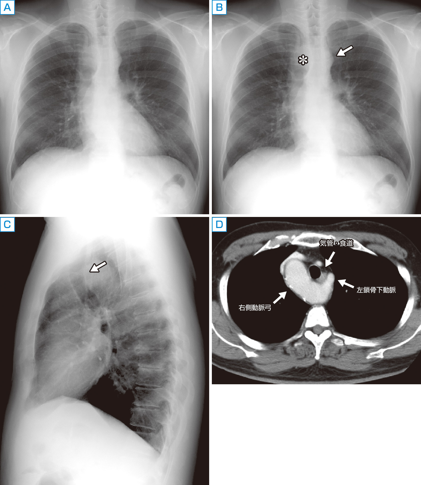 ⓔ図8-5-21　症例1：60歳代男性，糖尿病の教育入院時の胸部単純X線写真 　まず目につくのは下行大動脈の蛇行であるが，その上方，いわゆる左第1弓の陰影が成人男性にしては奇妙に小さい (B)．また気管右側の陰影が通常より幅広く，白くみえる (B＊)．よくみると気管は左に若干圧排されている．側面像では気管が前方に圧排されている (C矢印)．CTが撮影され，異所性左鎖骨下動脈を伴う右側大動脈弓と診断された (D)． 　胎生期において腹側大動脈と左右1対の背側大動脈を結ぶ左右6対の大動脈弓が生じ，これらが退縮していくことで大動脈および腕頭動脈，総頸動脈，鎖骨下動脈が形成される．正常では左第4大動脈弓と左背側大動脈が大動脈弓になるが，左側が退縮し右側が遺残すると右側大動脈弓になる．右側大動脈弓では本症例のように左鎖骨下動脈が大動脈弓遠位から分岐し，気管・食道の背側を通るタイプが最も多く，血管輪による症状を呈することがある．対して弓部の血管分岐が正常の左大動脈弓と鏡像であるタイプ (左腕頭動脈，右総頸動脈，右鎖骨下動脈の順に分岐するタイプ) では先天性心疾患を合併することが知られている．本症例でみられた気管の変位は異所性左鎖骨下動脈によるものであった．気管の変位や狭窄は悪性腫瘍や甲状腺腫などで起こることもあり見逃さないようにしたい．