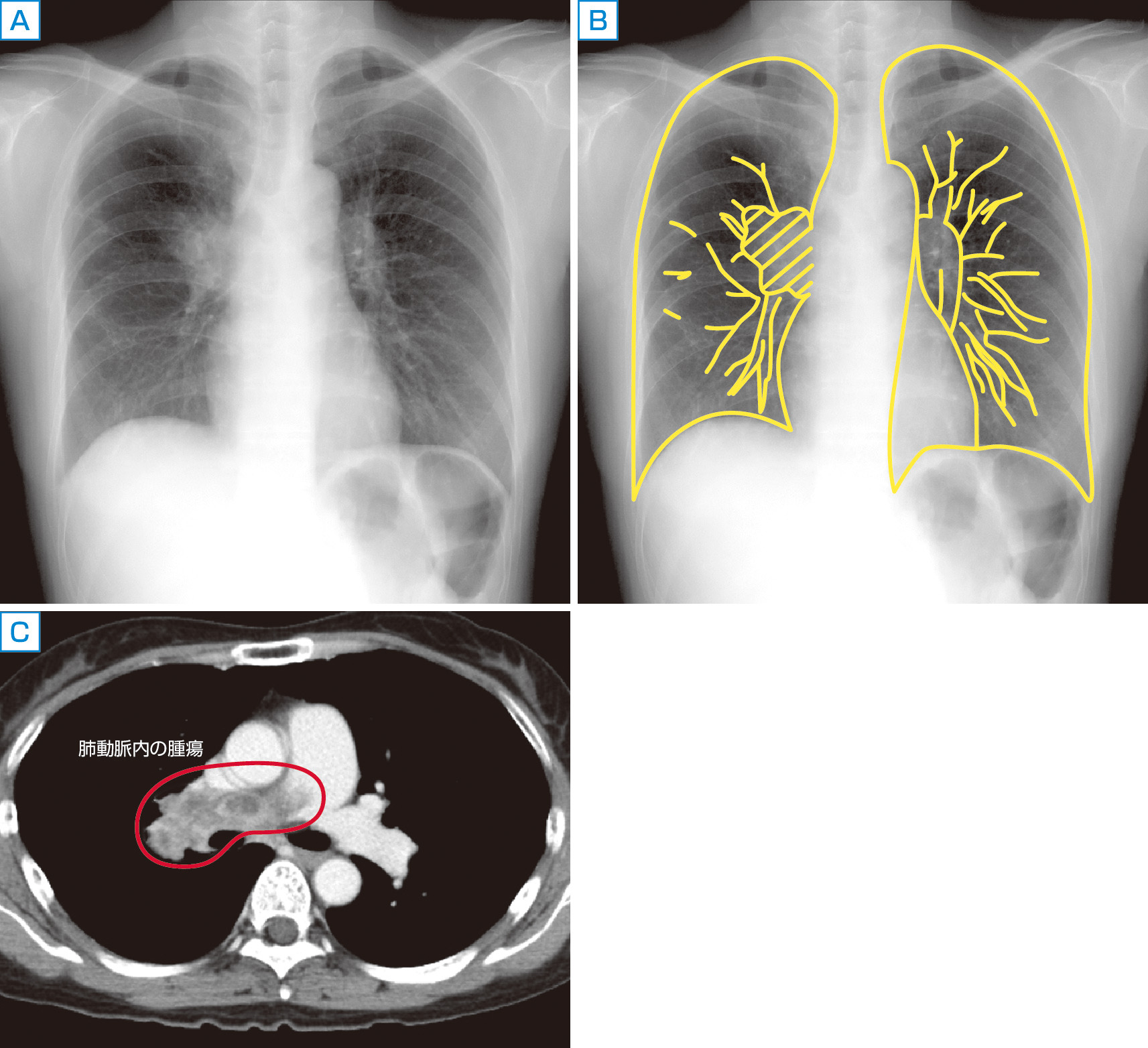 ⓔ図8-5-22　症例2：50歳代女性，意識消失発作のエピソード，呼吸困難，喀血のエピソードあり 　まず全体をみると右肺が全体に対側より若干小さいことがわかる．微妙な違いなのでわかりにくいかもしれないが，右上中肺野などで右側が対側より若干黒くみえないだろうか．詳しくみると右肺では全体に血管影が全体に乏しく，枯れ枝のようである．中下肺野で肺血管の径を比べると分かりやすいであろう．一方，肺門は右のほうが若干白くみえることに注目していただきたい．右肺動脈の輪郭が膨隆しており腫瘤影を呈している．その他，右中肺野などで結節影や索状影も少しみられる．シェーマをBに示しておく． 　精査の結果，右肺動脈主幹部内腔を占拠する腫瘍が認められ，病理は内膜肉腫であった (C)．本症例では腫瘍が右肺の血流を阻害しているため肺血管影が減弱したと考えられる．胸部X線写真の読影においては肺 (胸郭) の大きさや濃淡の左右差などにも注目して，異常を見逃さないようにしたい．X線写真で片側が対側より黒くみえる場合は閉塞性肺疾患やブラなど肺の異常，気胸，肺血管影の減弱，乳房切除後などの可能性を考える．逆に白くみえる場合は，肺炎や無気肺，胸水貯留，腫瘤などを検討する．その他，ポータブル撮影などで斜位がかかっている場合も左右差が生じることがあるので注意する．