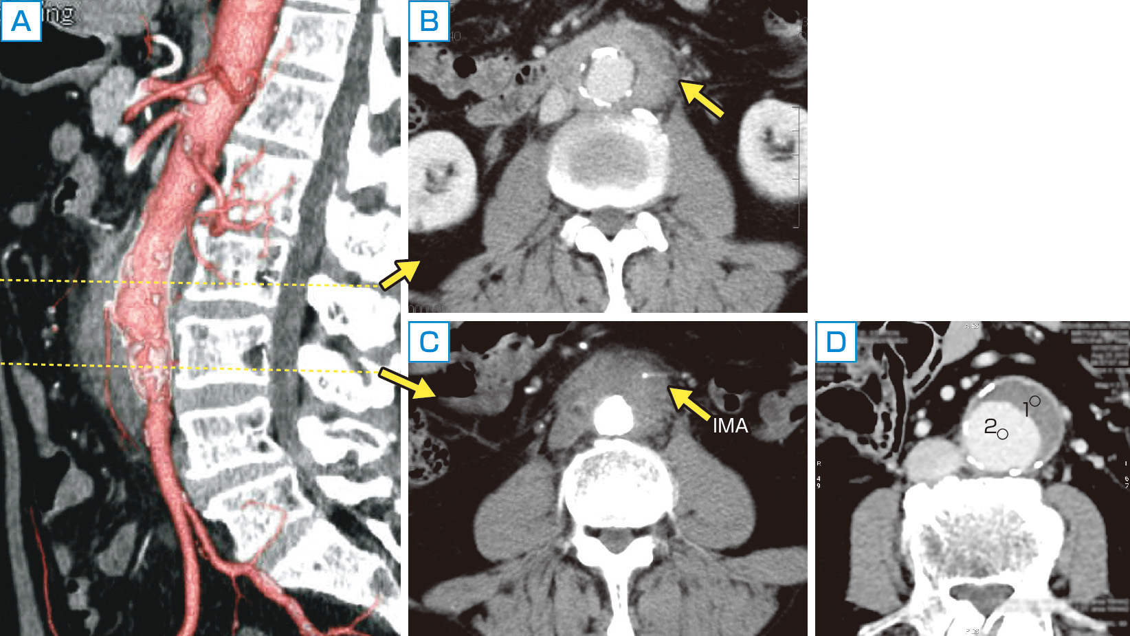 ⓔ図8-5-25　大血管のCT血管造影―IgG4関連大動脈周囲炎 (A～C) とアテローム性腹部大動脈瘤 (D) 81歳，男性．IgG4 286 mg/dL，自己免疫性膵炎，後腹膜線維症を伴うIgG4関連大動脈周囲炎の腹部造影CTの三次元像 (A) と各々の断面像 (B，C) を示す．血管壁周囲に造影効果を伴う肥厚を認め，下腸間膜動脈 (IMA) 周囲まで波及している．一方，動脈硬化性腹部大動脈瘤では，内膜中膜層の肥厚を伴い，造影効果のない基質化した壁在血栓を示している (D)．