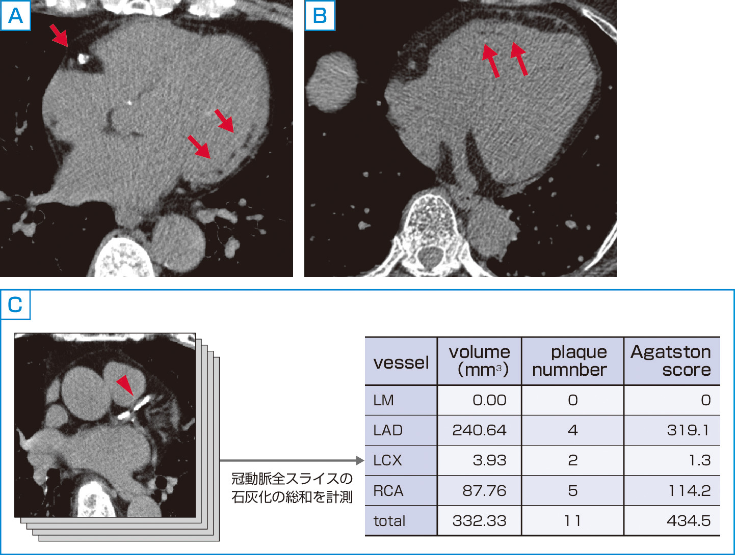 ⓔ図8-5-26　非造影CTによる評価 A：左室後壁心内膜側に梗塞巣を示す低吸収域を認める (矢印)． B：右室自由壁心内膜側に脂肪変性を示す低吸収域を認める (矢印)． C：右冠動脈には石灰化病変を認める (矢頭)．冠動脈全体のカルシウムの総和を定量するカルシウムスコアは冠動脈疾患のリスク評価として用いられる．
