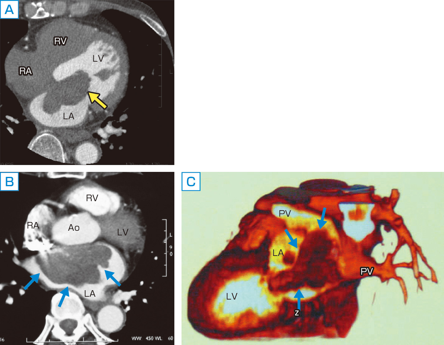 ⓔ図8-5-27　心臓腫瘍 (左房粘液腫と血管肉腫) A：左房粘液腫 (体軸像)，B：左房原発血管肉腫 (体軸像)，C：左房原発血管肉腫三次元像． 拡張期体軸水平断面．心房中隔から左房内に突出する有茎性の腫瘤があり，左室内への嵌入を認める．術後の病理組織検査では粘液腫であった ([★動画URL★ ⓔ動画8-5-10])．一方，左房内に辺縁不整で内部の不均一な無茎性の腫瘤を認める．三次元像でも左房内に充実した肺動脈瘤像を認めた．術後の病理組織検査では血管肉腫であった．