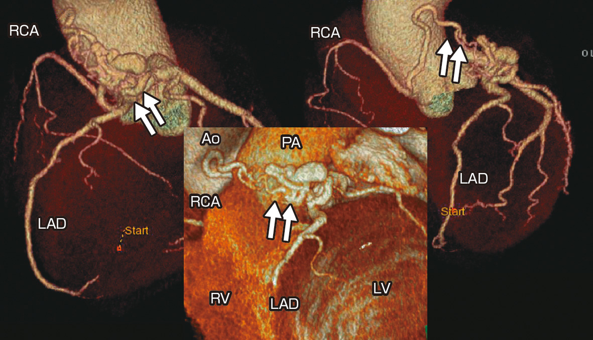 ⓔ図8-5-28　冠動脈肺動脈瘻 左冠動脈前下行枝および右冠動脈より肺動脈への一部瘤化した冠動脈肺動脈瘻を認める (矢印)． Ao：大動脈，LA：左房，LAD：左前下行枝，LV：左室，RV：右室，RCA：右冠動脈．