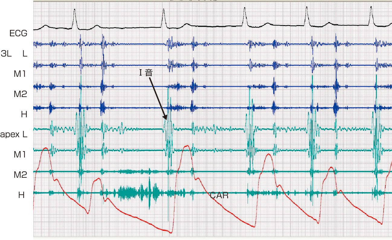ⓔ図8-5-3　Ⅰ音の亢進 (僧帽弁狭窄症) 心尖部でⅠ音の亢進を認める．