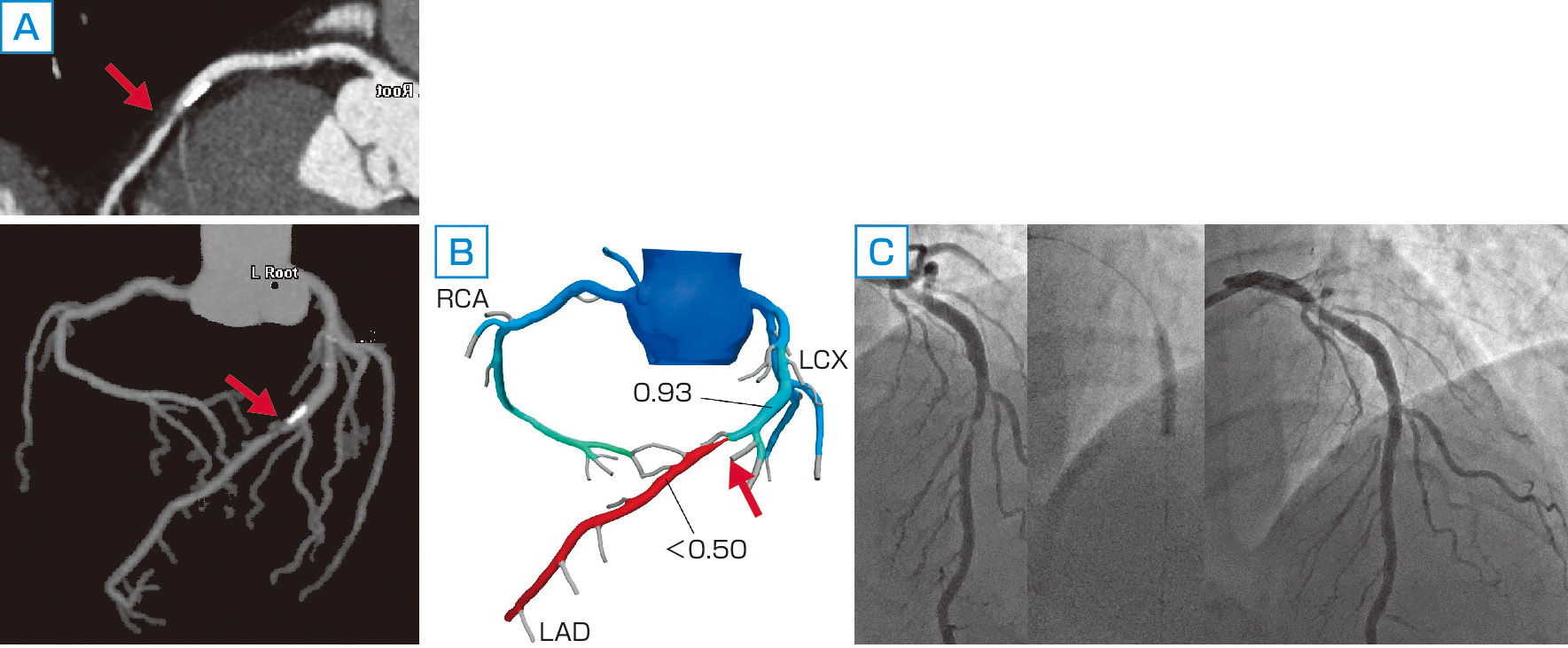 ⓔ図8-5-30　冠動脈CTによる冠血流予備能比 (FFRCT) 測定 (症例提供：順天堂大学藤本進一郎先生) 60歳，男性．労作性狭心症で冠動脈CT血管造影を施行した．左前下行枝中間部 (AHA セグメント #7) 70％狭窄 (A，矢印) にFFRCT 解析を行った (B)．狭窄部末梢側でFFRは0.5未満まで低下し，虚血陽性と判断した．この患者は，後日冠動脈造影を行い，同部位の有意狭窄病変にステント留置術を施行した (C)．