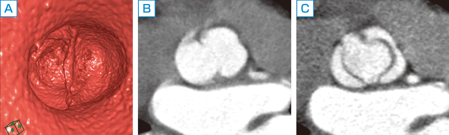 ⓔ図8-5-31　大動脈弁二尖弁 大動脈弁二尖弁のCT像．A：拡張期VR像，B：拡張期MPR像 (multiplanar reconstruction)，C：収縮期MPR像．