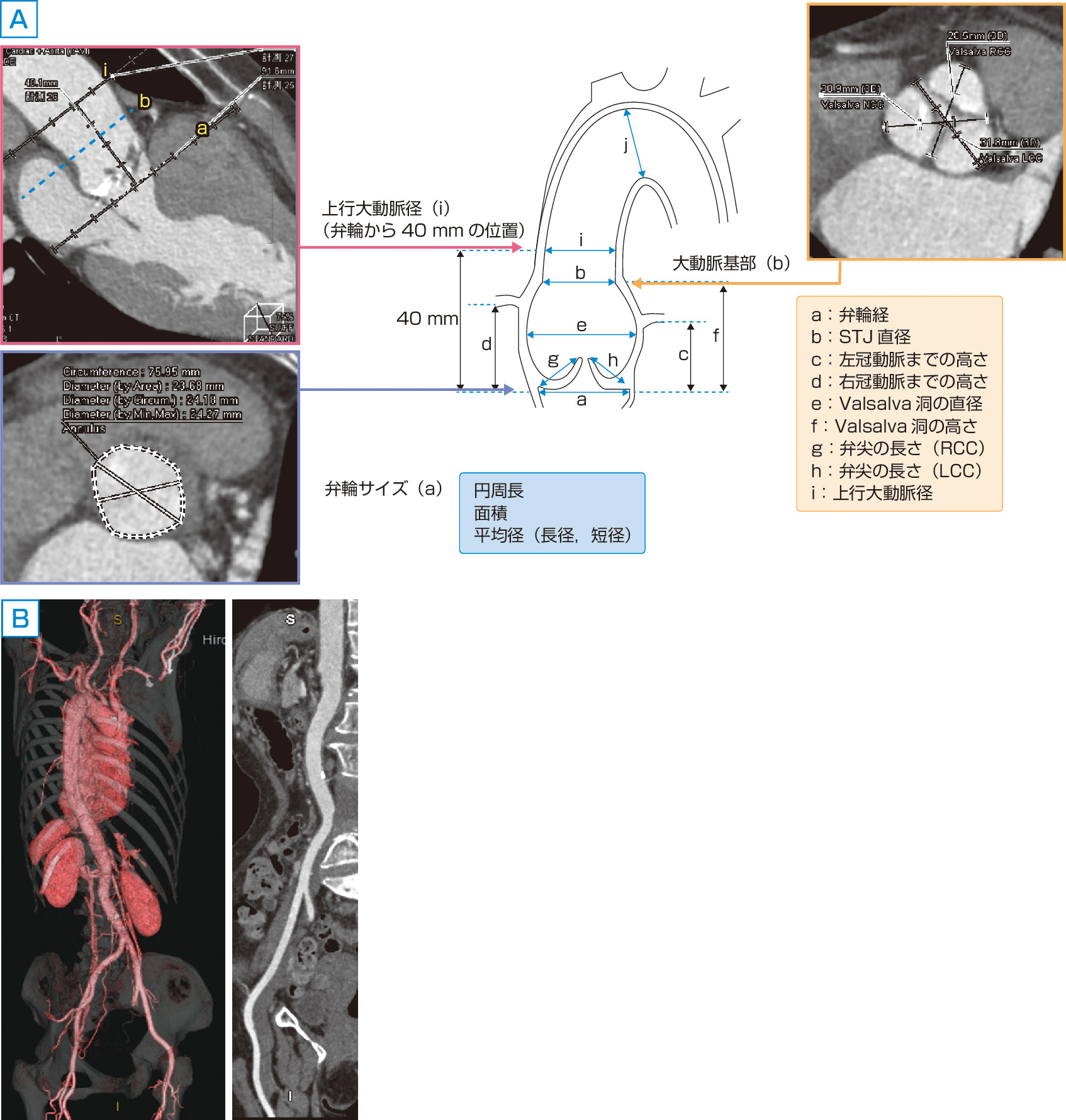 ⓔ図8-5-32　経カテーテル大動脈弁置換術への応用 A：大動脈弁輪から大動脈弓の計測，B：access rootの評価 (大動脈～腸骨動脈の三次元画像とMPR像)．
