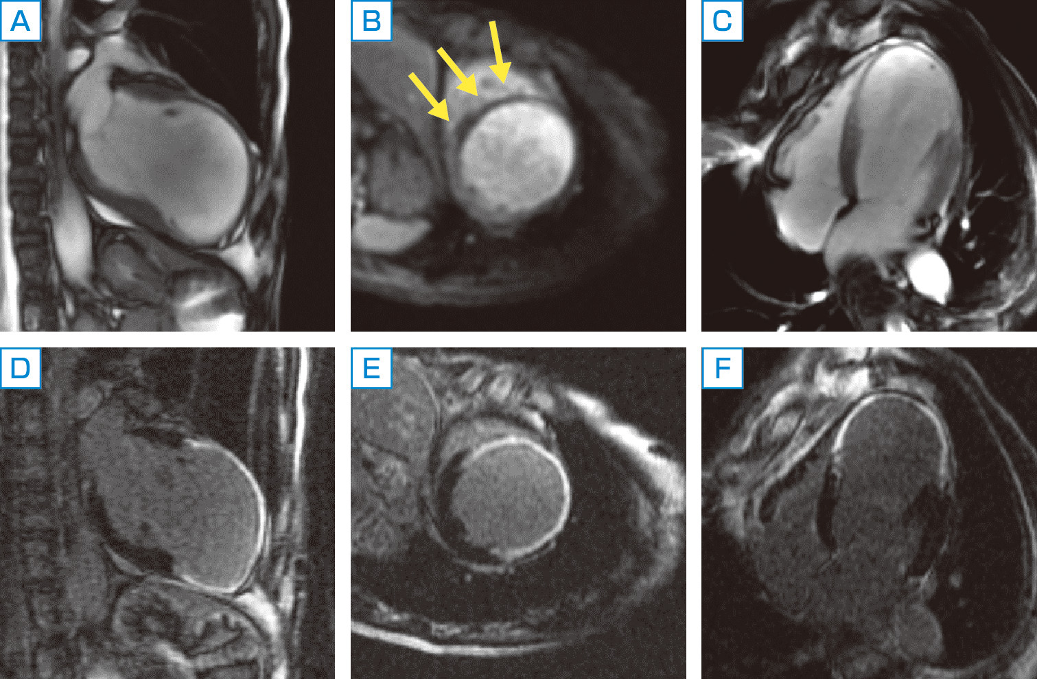 ⓔ図8-5-33　虚血性心疾患 (陳旧性心筋梗塞) のMRI A～C：シネ画像では左室広範前壁は菲薄化し心腔拡大を認める．また，低信号領域 (矢印) も認め，左前下行枝領域の血流低下を示唆する． D～F：菲薄化した左室壁に一致してガドリニウム遅延造影を認める．菲薄化はほぼ全層に及ぶことからバイアベリティはなく心筋壊死していることが示唆される．