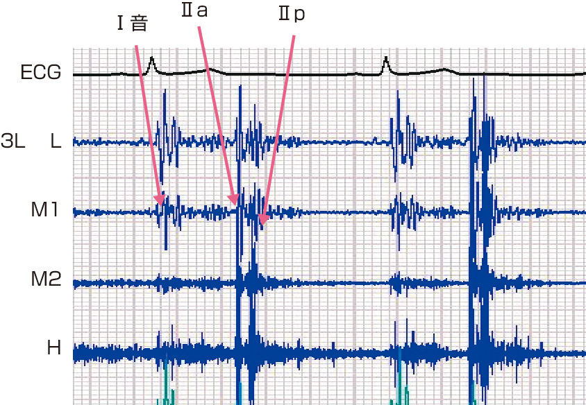 ⓔ図8-5-4　Ⅱ音の分裂 (3Lの記録) Ⅱ音は大動脈弁成分 (Ⅱa) と肺動脈弁成分 (Ⅱp) に分裂している．