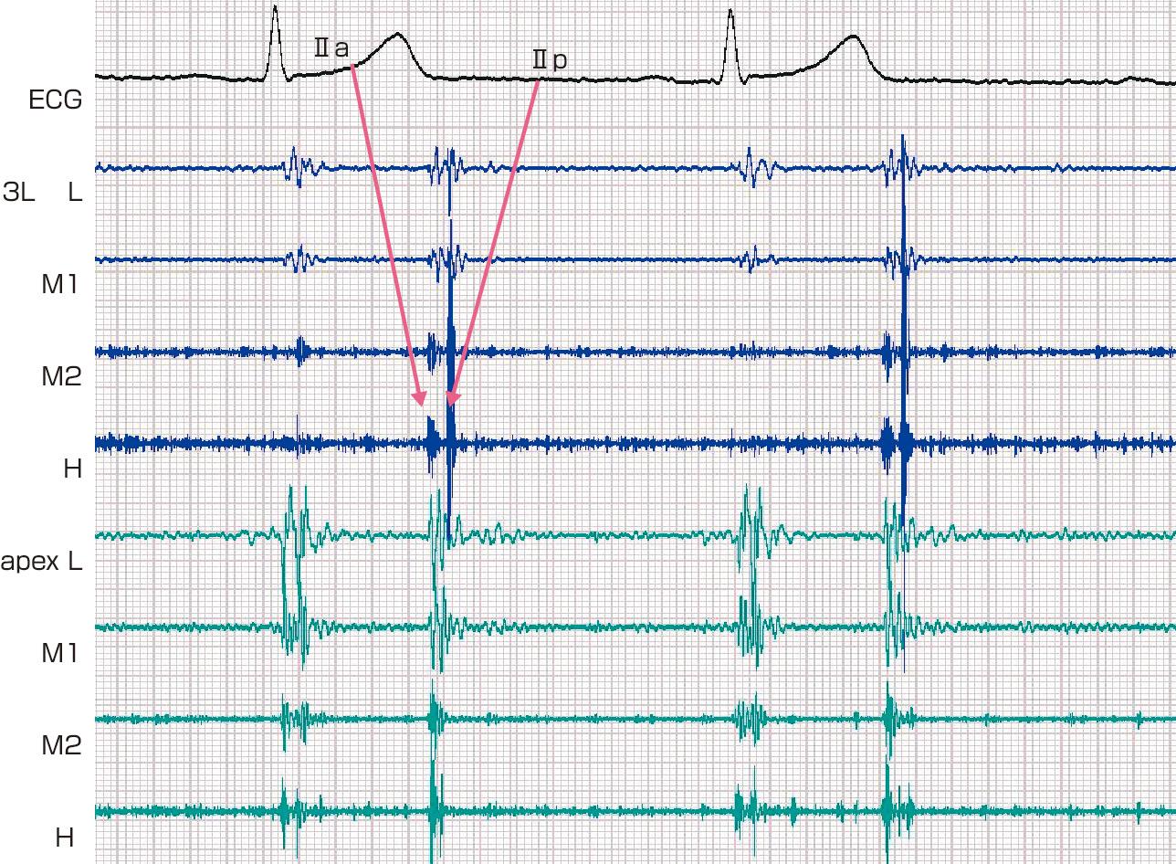 ⓔ図8-5-5　Ⅱpの亢進 3LでⅡpがⅡaより大きく，また心尖部でⅡpが記録されている．