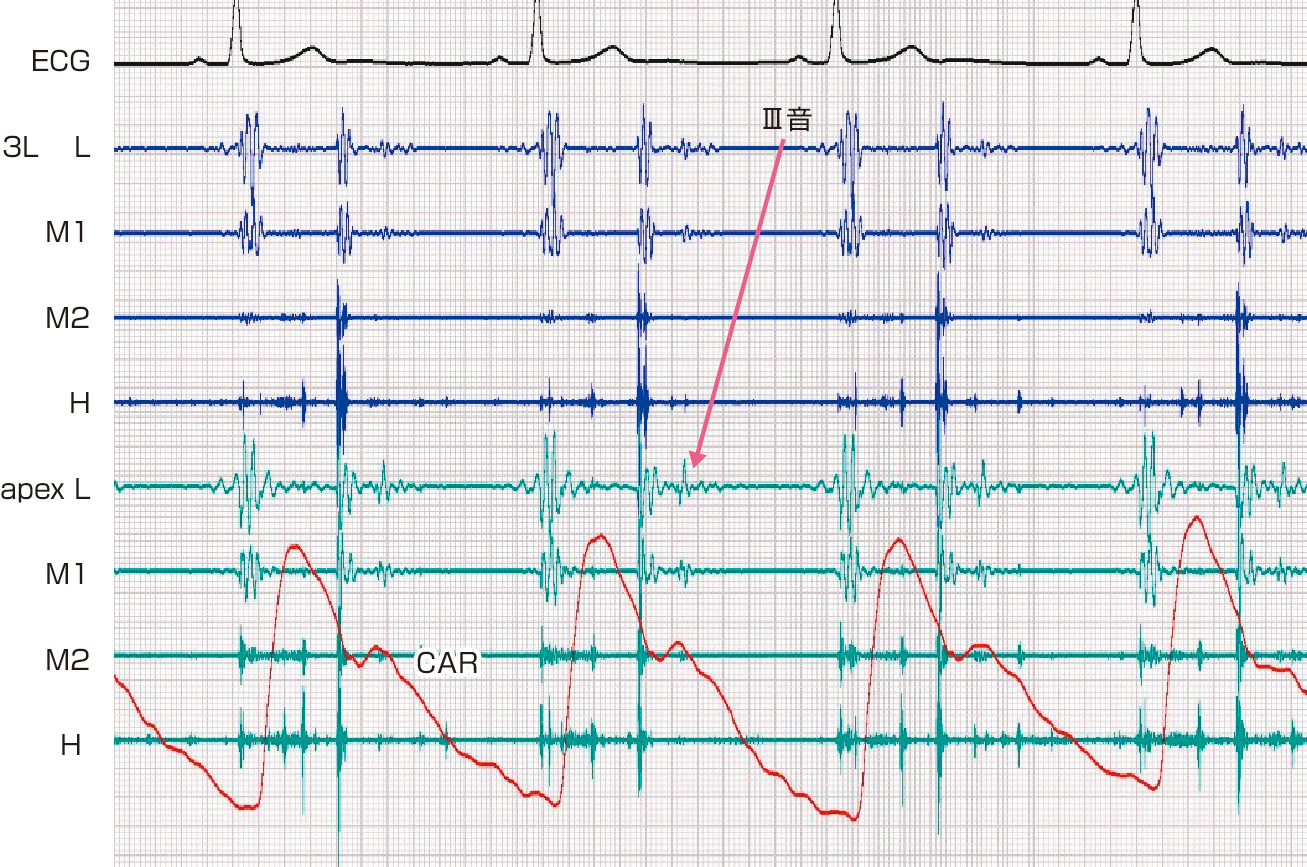 ⓔ図8-5-6　Ⅲ音 心尖部の低音部で拡張早期にⅢ音が記録されている．