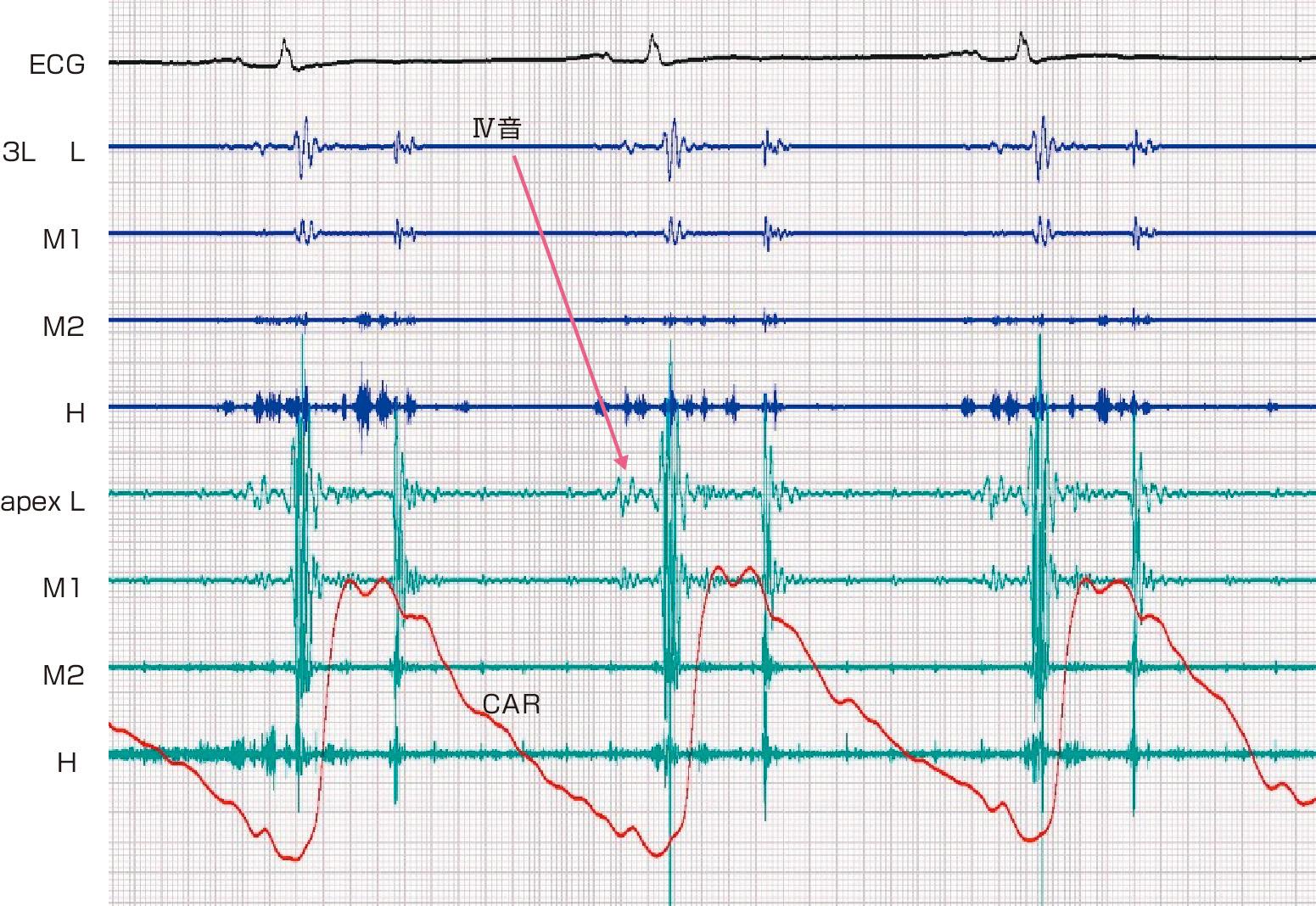 ⓔ図8-5-7　Ⅳ音 心尖部の低音部で拡張末期にⅣ音が記録されている．