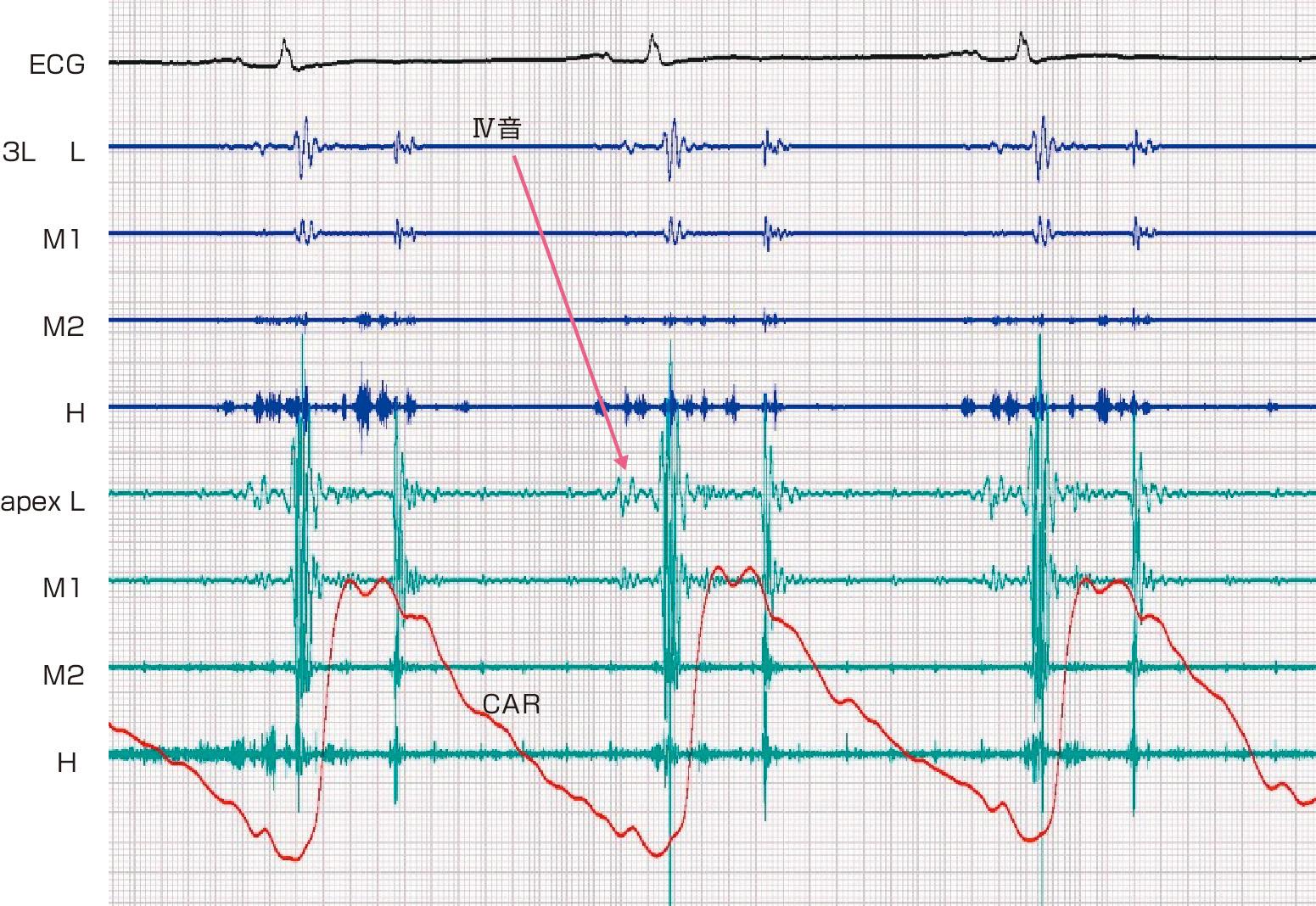 ⓔ図8-5-7　Ⅳ音 心尖部の低音部で拡張末期にⅣ音が記録されている．