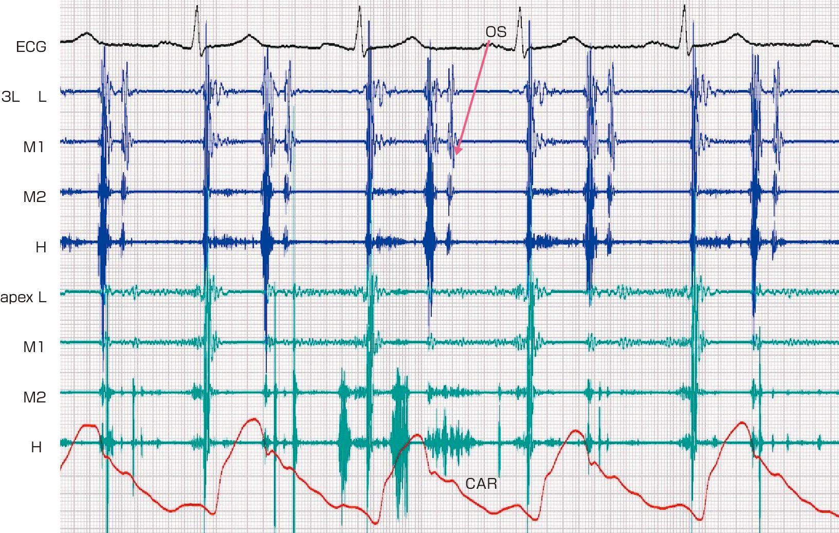 ⓔ図8-5-8　opening snap (OS) (僧帽弁狭窄症例) 3Lで拡張早期にOSを認める．