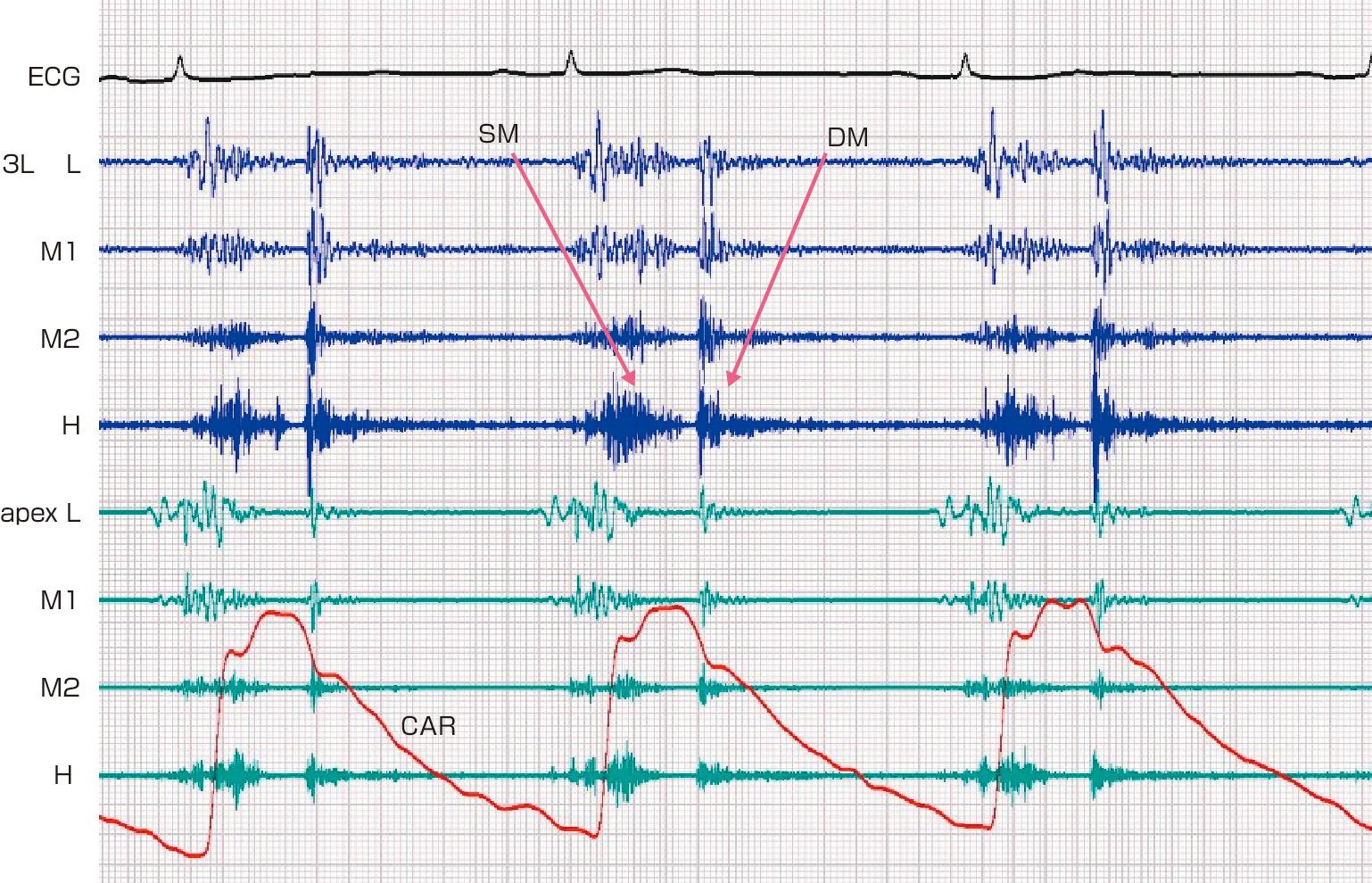 ⓔ図8-5-9　往復雑音 (大動脈弁閉鎖不全例) 拡張期雑音 (DM) と収縮期雑音 (SM) が記録されている．
