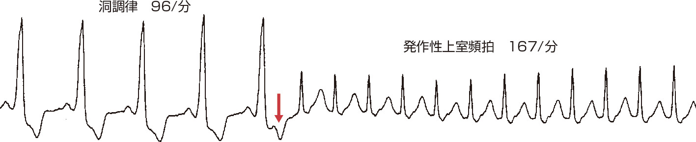 ⓔ図8-6-1　WPW症候群における発作性上室頻拍 (平尾見三：内科学第11版 (矢﨑義雄総編集)．朝倉書店，2017) WPW症候群において心房期外収縮 (矢印) を契機にnarrow QRS頻拍が発生している．