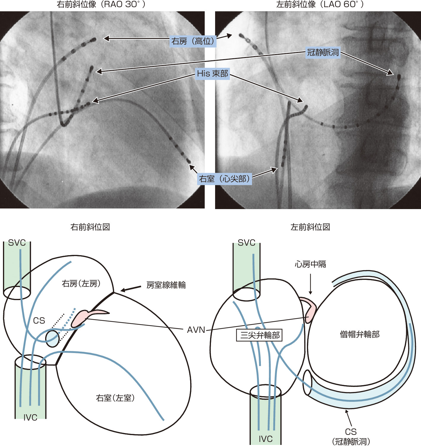 ⓔ図8-6-2　電極カテーテルの留置部位のX線透視像およびシェーマ (平尾見三：内科学第11版 (矢﨑義雄総編集)．朝倉書店，2017) 