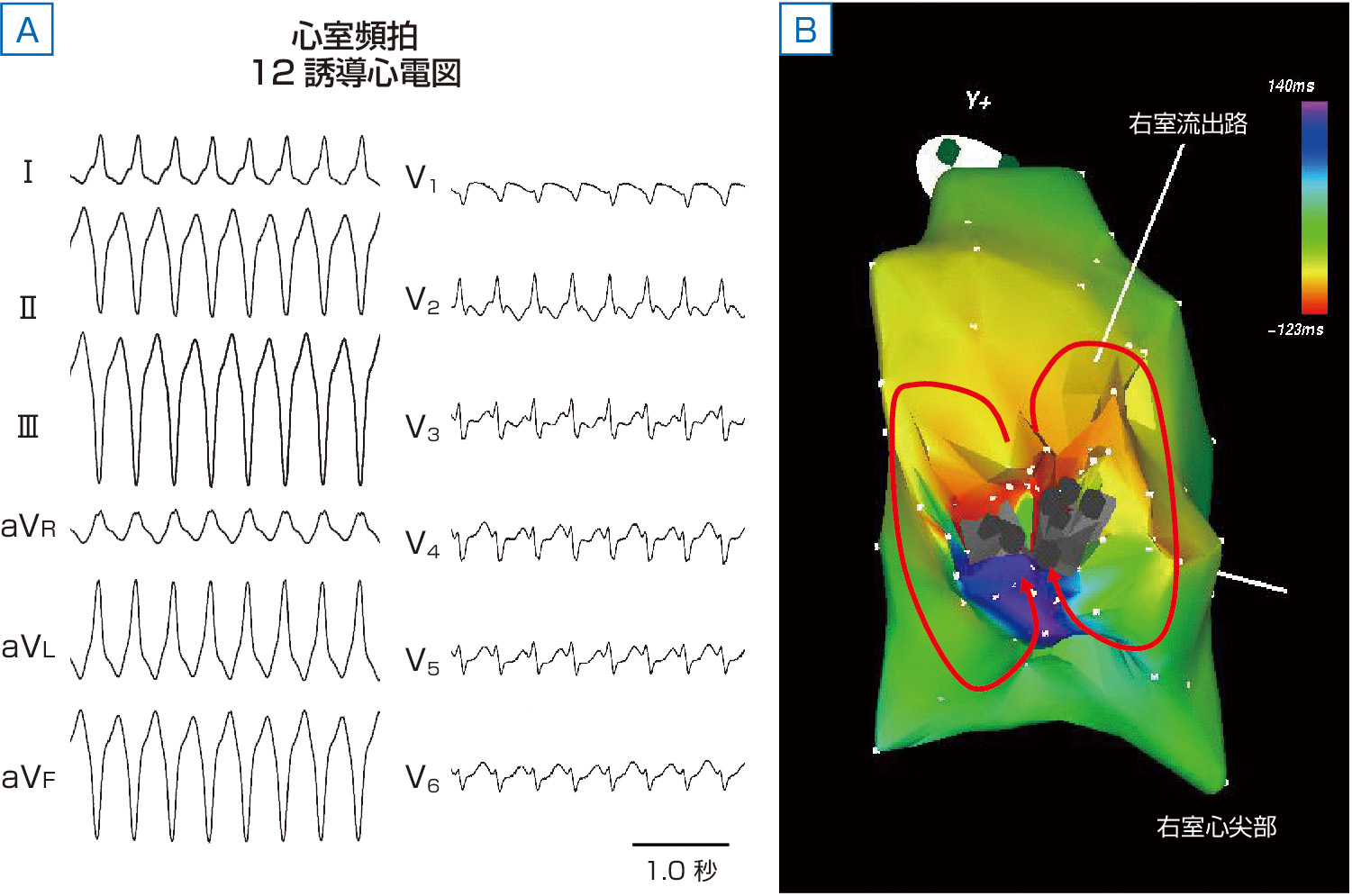 ⓔ図8-6-3　単形性持続性心室頻拍におけるリエントリー回路の回旋パターン A：不整脈原性右室心筋症にて記録された心室頻拍時の12誘導心電図 (左) と頻拍中に記録された心室の伝導パターンを示す．心電図では自然停止しない持続性心室頻拍を示し，発生機序としてリエントリーが示唆される． B：3Dマッピングシステムを用いて心室頻拍中に描かれた伝導パターン．右室下壁自由壁に灰色で示す2つの瘢痕が存在し，その間に存在する心筋を中心にして，赤→黄→緑→青の順で8の字型に回旋する経路 (赤い曲線で示す回路) が再現されている．瘢痕の間にはさまれた心筋にリエントリーの温床となる伝導遅延部位が存在している．このように頻拍回路が一定のパターンをとると，心室頻拍は単形性を示す．