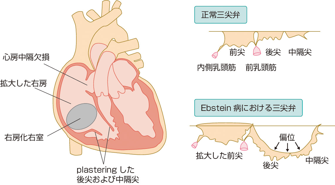 ⓔ図8-8-12　Ebstein病 A：心内構造，B：三尖弁のplastering．