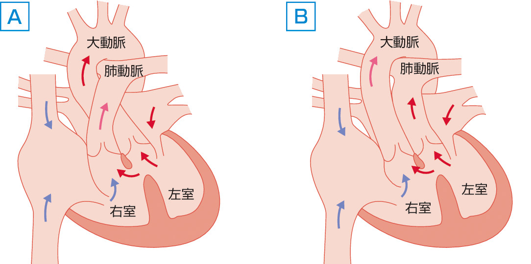 ⓔ図8-8-13　両大血管右室起始 (DORV) A：大動脈弁下VSD，B：肺動脈弁下VSD．