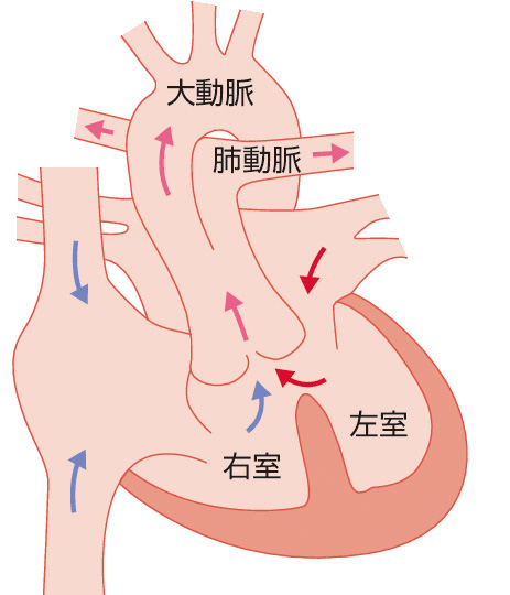 ⓔ図8-8-14　総動脈幹遺残 (PTA) 