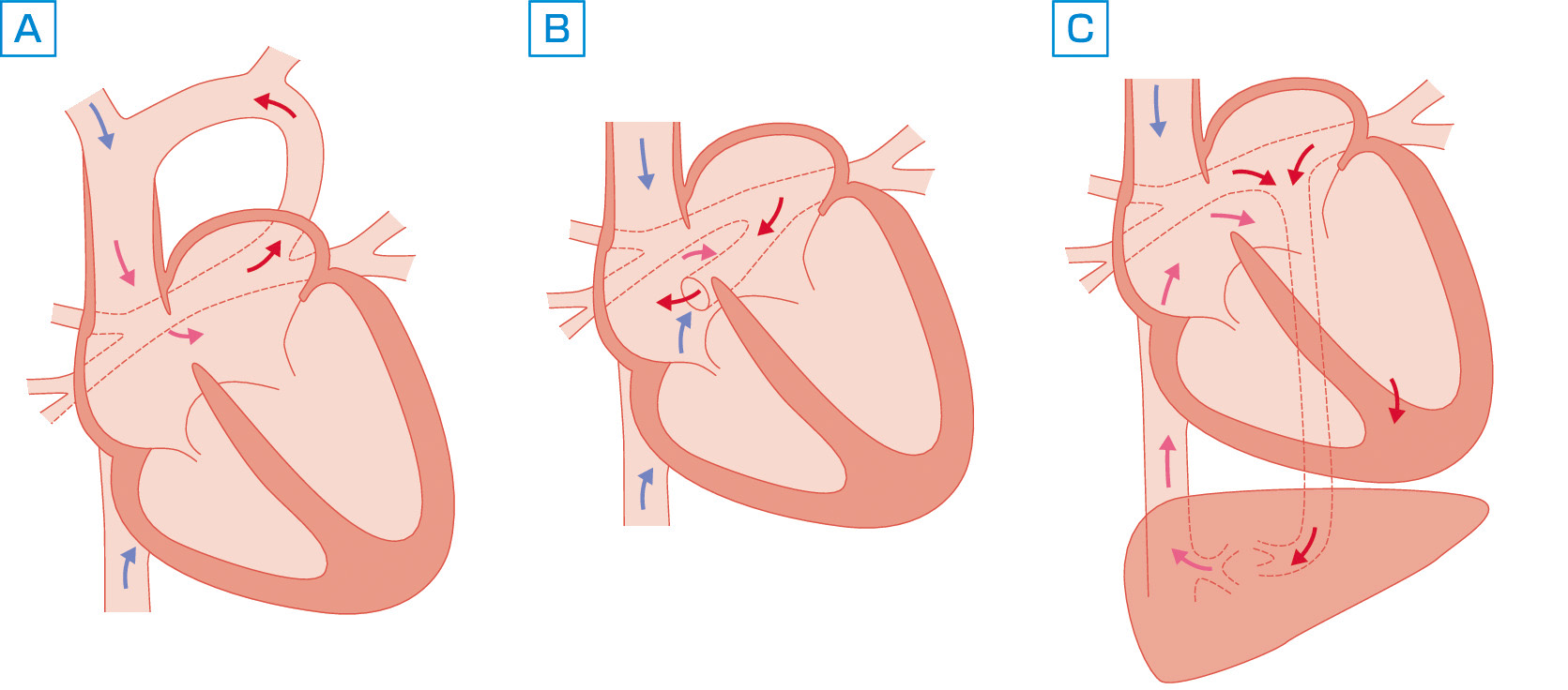 ⓔ図8-8-15　総肺静脈還流異常 (TAPVD) A：Ⅰa型，B：Ⅱa型，C：Ⅲ型．