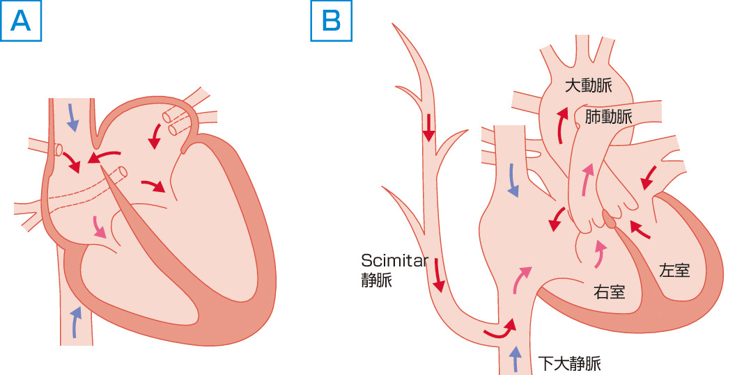 ⓔ図8-8-16　部分肺静脈還流異常 (PAPVD) (A，右上肺静脈上大静脈還流型) とScimitar症候群 (B) 