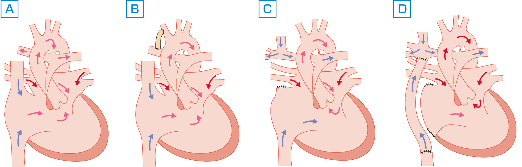 ⓔ図8-8-18　単心室 (SV) 疾患における段階的手術 A：肺動脈閉鎖を伴う単心室，B：Blalock–Taussig短絡術後，C：両方向性Glenn手術後，D：Fontan手術後．