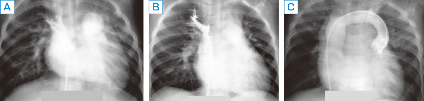ⓔ図8-8-2　二次孔欠損に合併しうる部分的肺静脈還流異常 A：右上肺静脈還流異常，B：右上肺静脈還流異常，C：左肺静脈還流異常． A, B：右上肺静脈が上大静脈に注ぐ． C：左上肺静脈が無名静脈に注ぐ．