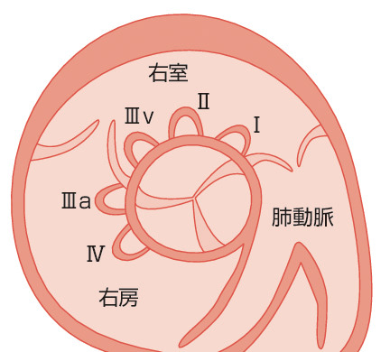 ⓔ図8-8-20　先天性心疾患に基づくValsalva洞動脈瘤の分類 Ⅰ型：右冠尖から肺動脈弁直下に向かう，Ⅱ型：右冠尖から右室流出路に向かう，Ⅲv型：右冠尖から右室流出路に向かう，Ⅲa型：右冠尖から右房に向かう，Ⅳ型：無冠尖から右房に向かう．