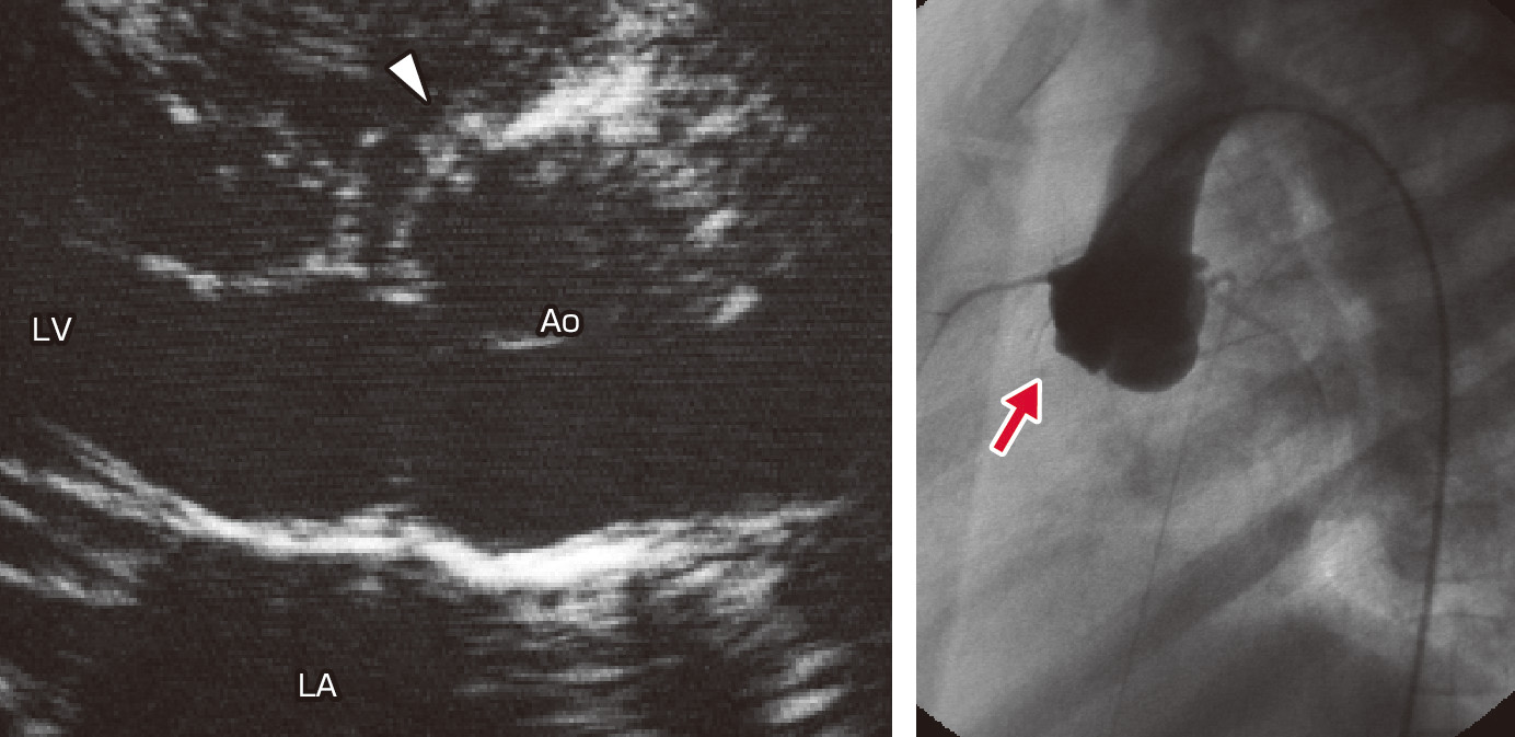 ⓔ図8-8-3　肺動脈弁下型に伴う右冠尖逸脱 (矢印) 