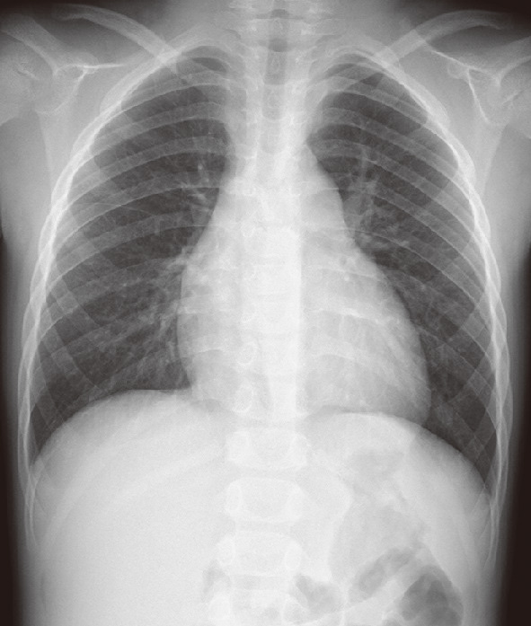 ⓔ図8-8-6　肺動脈弁狭窄 胸部X線 