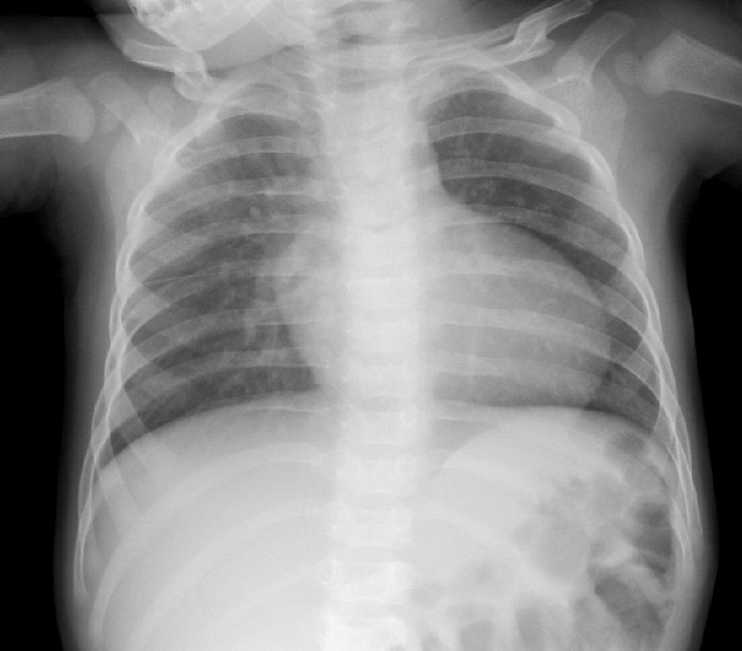 ⓔ図8-8-7　末梢性肺動脈狭窄 胸部X線 