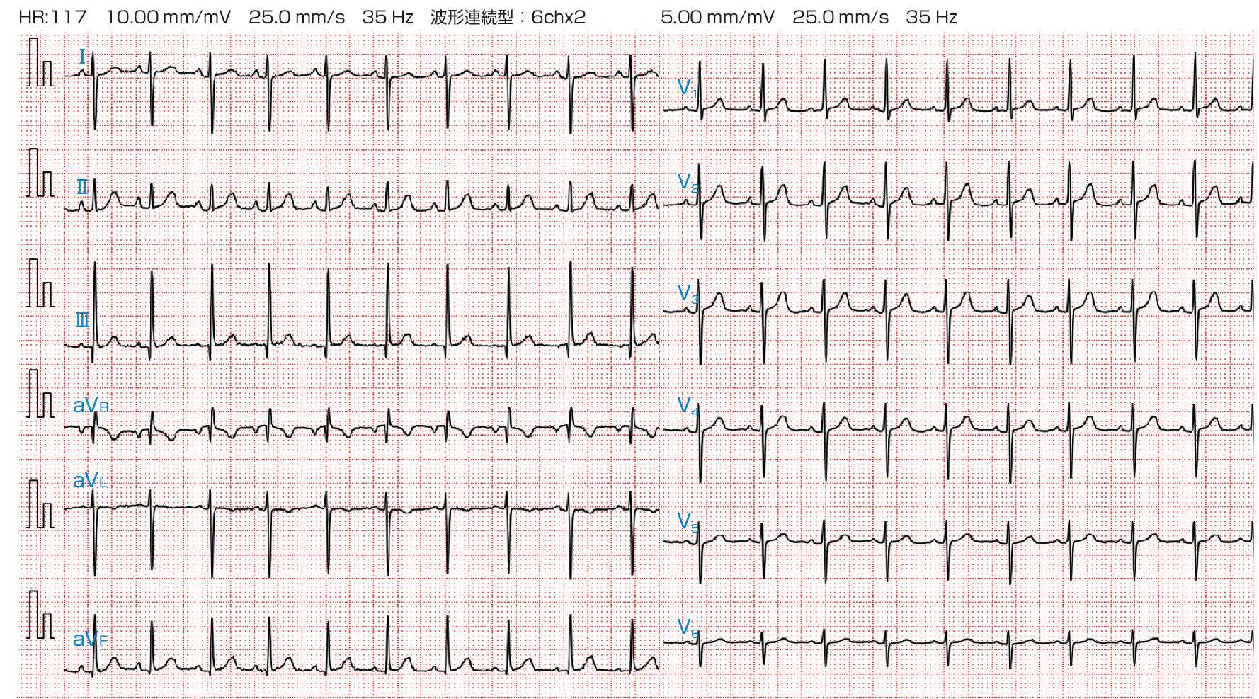 ⓔ図8-8-8　Fallot四徴症 心電図 洞調律，右軸偏位，右室肥大を認める．