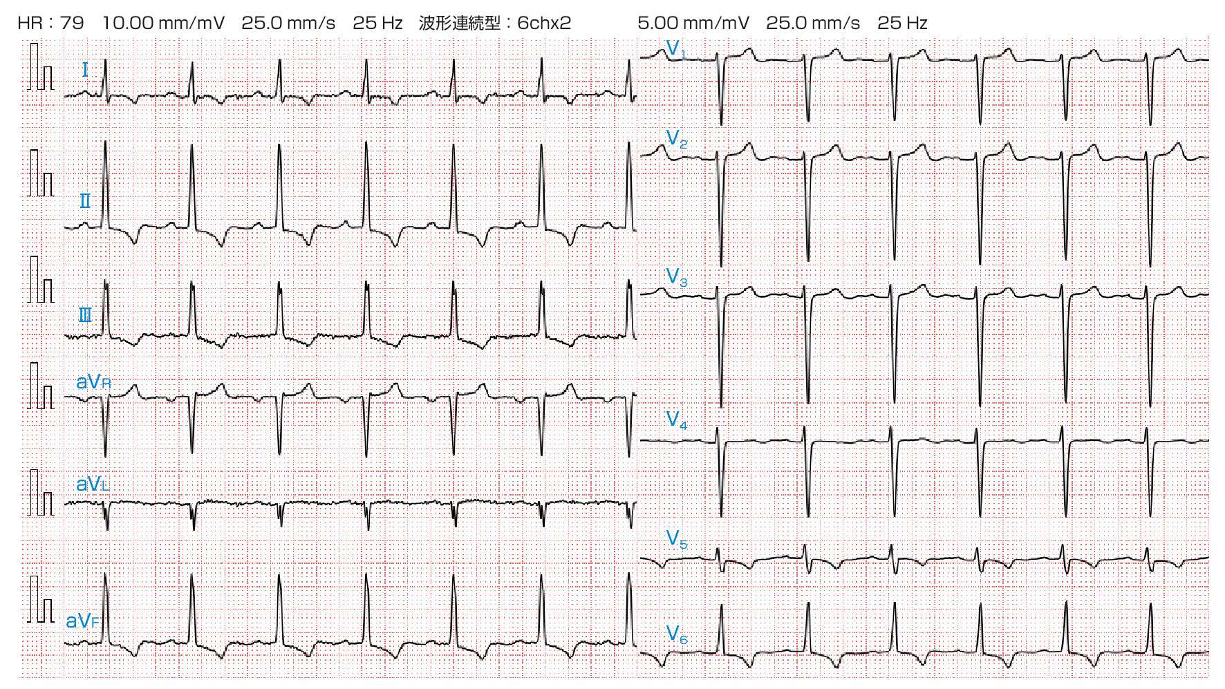 ⓔ図8-8-9　大動脈弁狭窄 心電図 洞調律，正常軸，V2 誘導で深いS波，(Ⅰ)，Ⅱ，Ⅲ，aVF およびV5，V6 誘導で陰性T波 (ストレインパターン) が認められる．